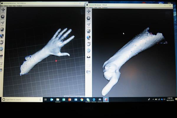 約旦安曼無國界醫生中東沖突受害者提供3D打印假肢